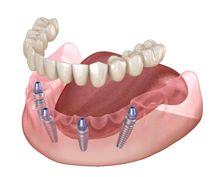Teeth being put into all on 4 implants, pascoe vale 