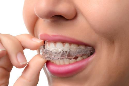 woman using clear braces | Dentist pascoe vale vic