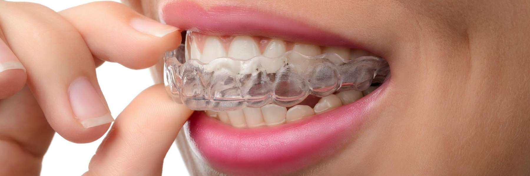 Woman inserting clear aligners, pascoe vale vic