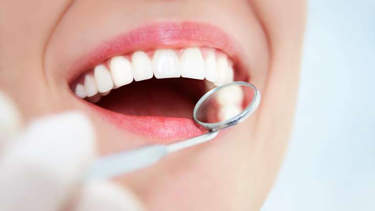 Small dental mirror tool next to an open mouth, pascoe vale vic