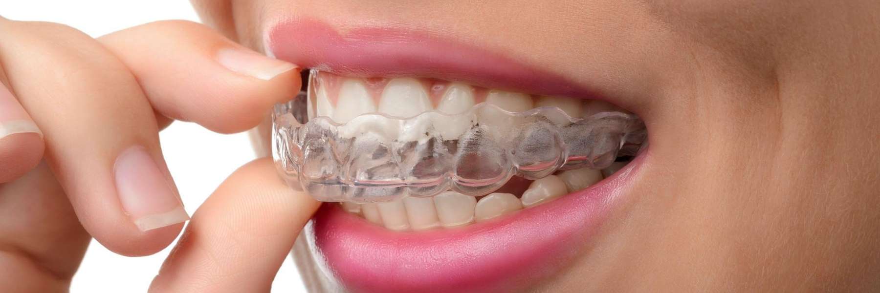 Woman taking invisalign aligner out of her mouth, pascoe vale vic