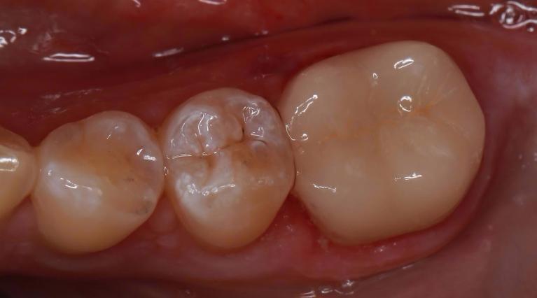 dental crown after image | pascoe vale dentist