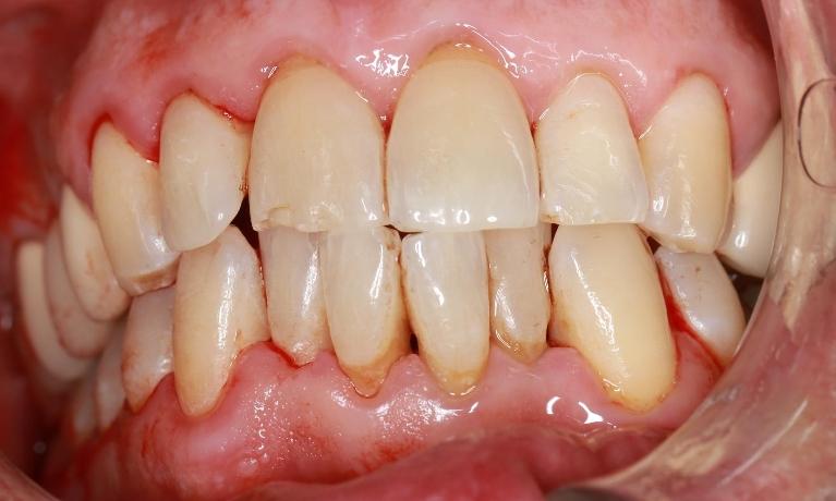 after deep cleaning | pascoe vale dentist