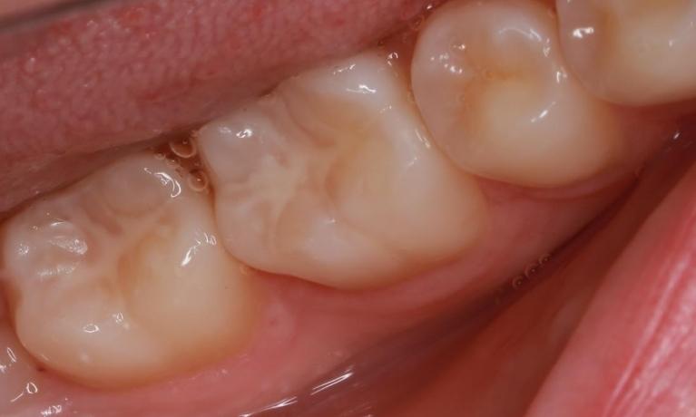Pit-and-Fissure-Sealants-After-Image