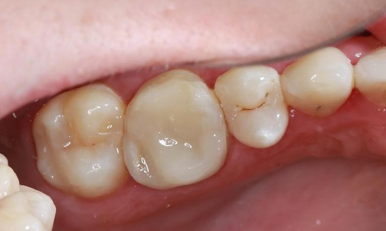 white cosmetic filling | pascoe vale dentist