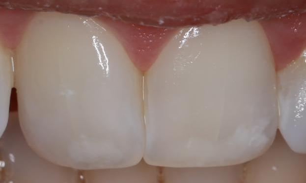 white spots on front teeth fixed | cosmetic dentist pascoe vale
