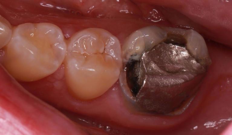 molar with silver filling | dentist pascoe vale vic