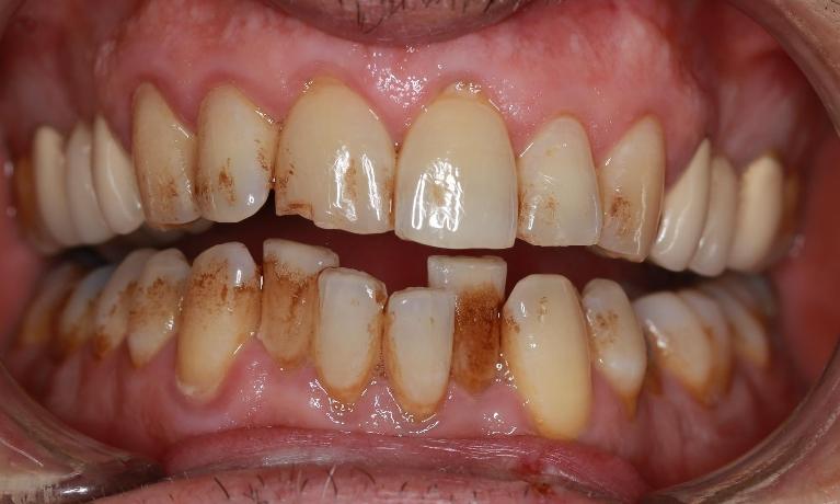 before deep cleaning | pascoe vale dentist