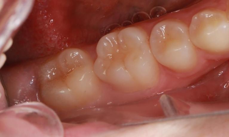 Pit-and-Fissure-Sealants-Before-Image
