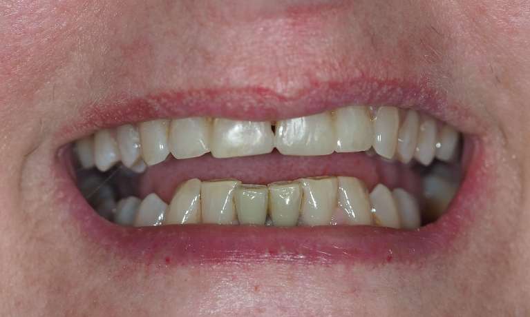 Broken-Tooth-After-Image