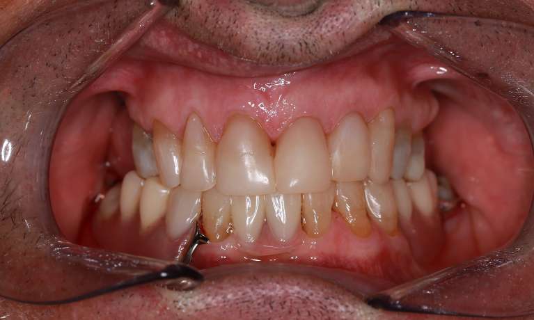View of mouth after composite bonding on front teeth, pascoe vale vic