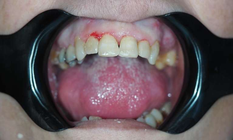 View of patients mouth after composite bonding, pascoe vale