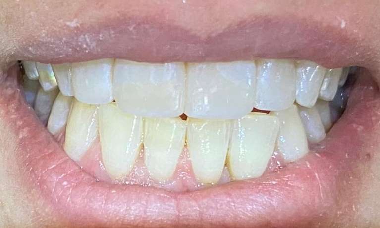 Composite-Fillings-After-Image