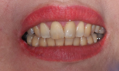 After treatment - Emergency Broken Tooth Repair