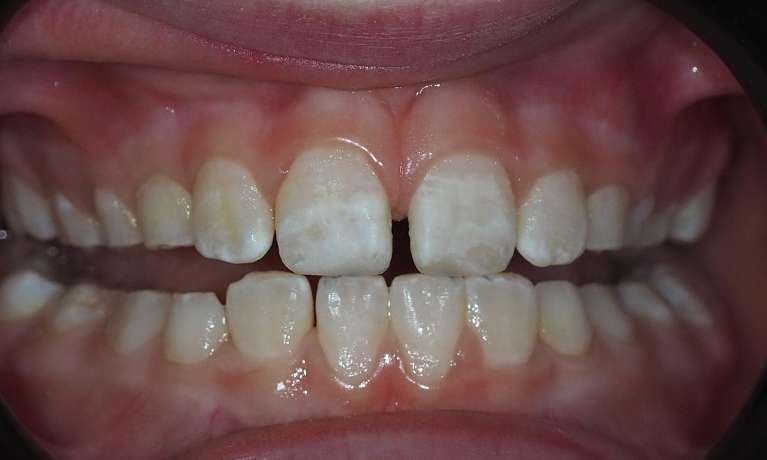 After Front Teeth Build-Up with Microabrasion and Remineralisation Therapy