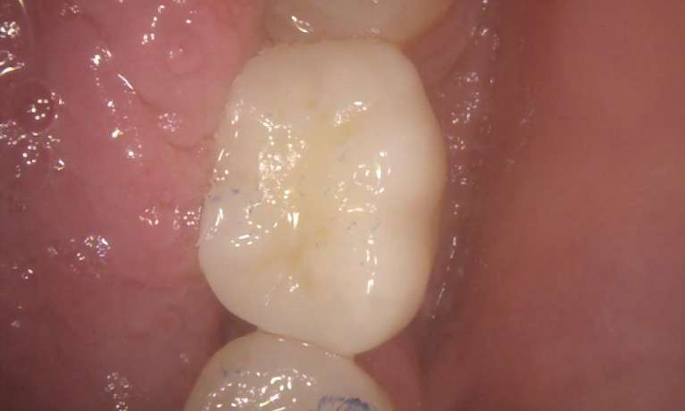 Before-and-After-Implant-Crown-Procedure-After-Image