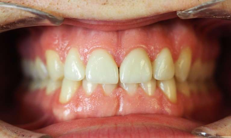Invisalign-and-Build-up-Front-Teeth-After-Image