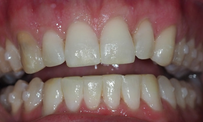 After treatment - Invisalign and Composite Bonding