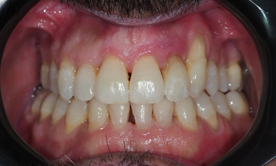 After treatment - Invisalign Clear Aligner Treatment