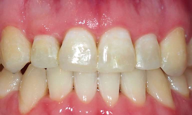 Orthodontic-Treatment-and-Composite-Buildup-of-Front-Teeth-After-Image