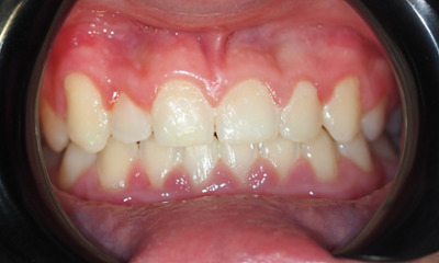 After treatment - Orthodontic Treatment