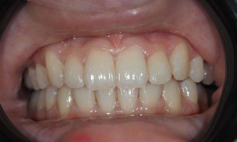 Overbite-Corrected-Using-Invisalign-After-Image