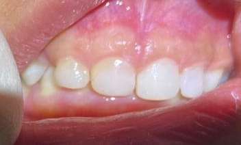 Paediatric-Composite-Fillings-After-Image