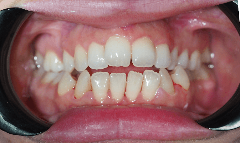 Close up of mouth after a professional dental clean, pascoe vale vic