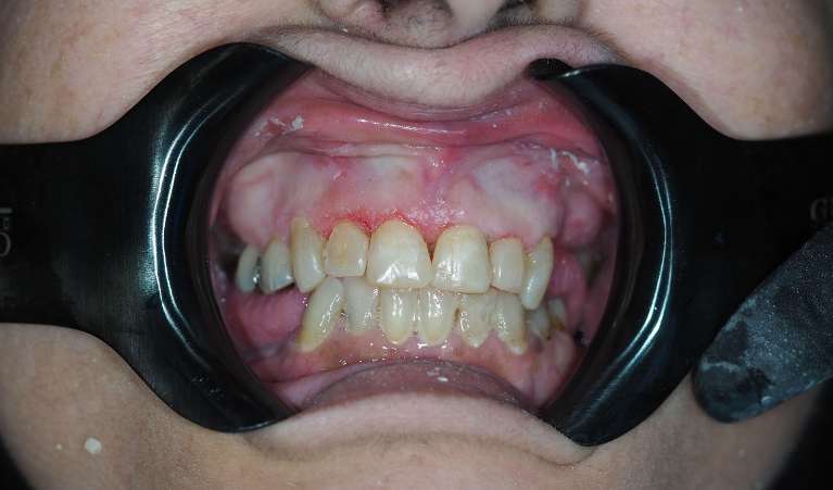 Secondary view of patients mouth after composite bonding, pascoe vale