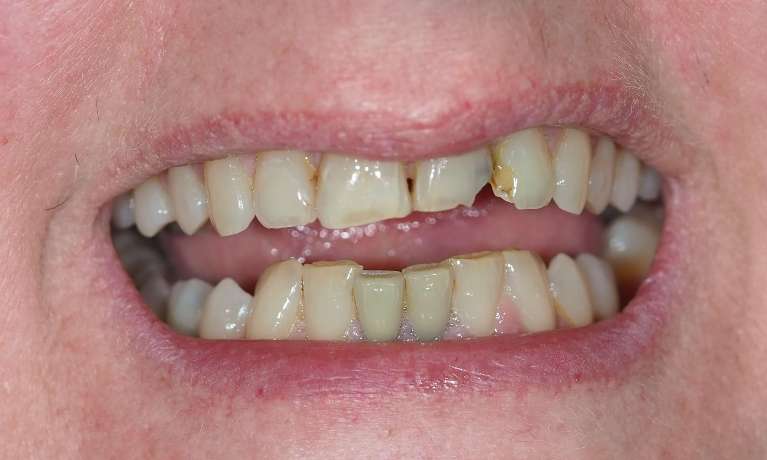 Broken-Tooth-Before-Image