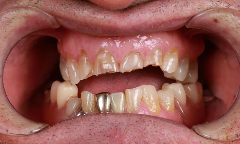 View of mouth before composite bonding on front teeth, pascoe vale vic
