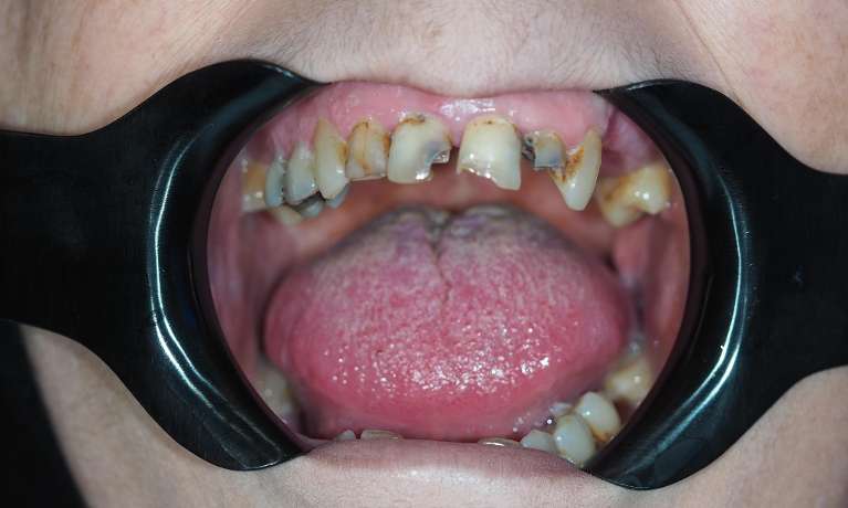 View of patients mouth before composite bonding, pascoe vale