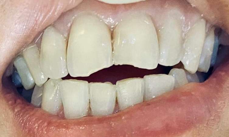 Composite-Fillings-Before-Image