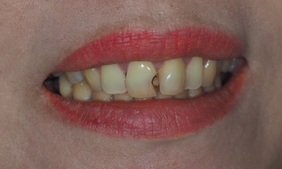 Before treatment - Emergency Broken Tooth Repair
