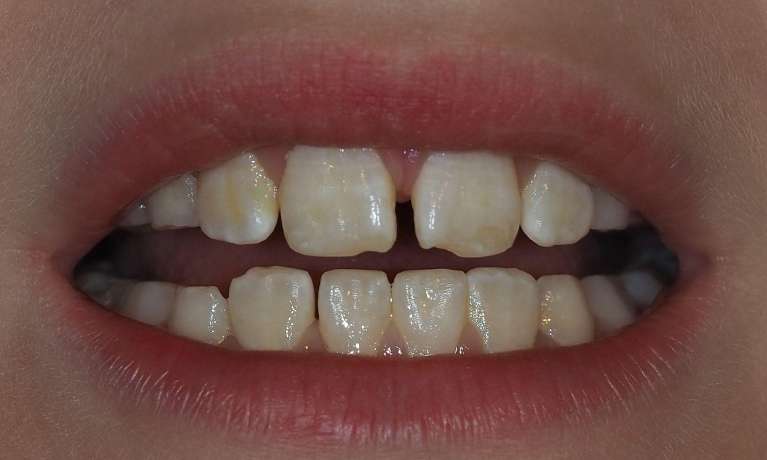 Before Front Teeth Build-Up with Microabrasion and Remineralisation Therapy