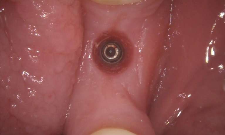 Before-and-After-Implant-Crown-Procedure-Before-Image