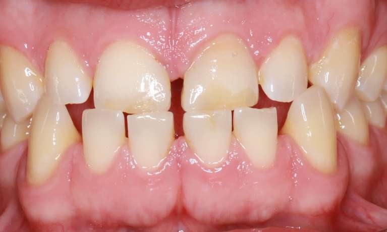 Invisalign-and-Build-up-Front-Teeth-Before-Image