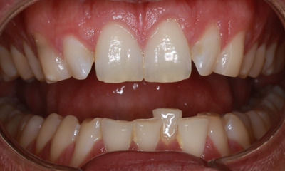 Before treatment - Invisalign and Composite Bonding