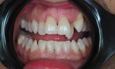 Before treatment - Invisalign Clear Aligner Treatment