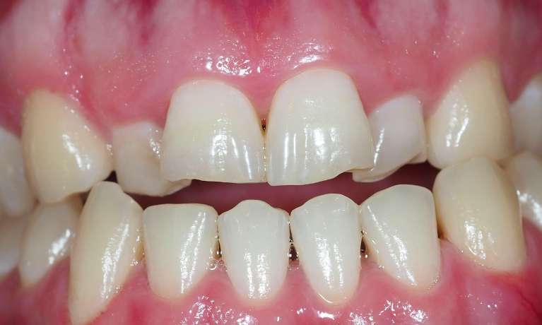 Orthodontic-Treatment-and-Composite-Buildup-of-Front-Teeth-Before-Image