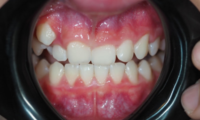 Before treatment - Orthodontic Treatment
