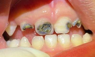 Paediatric-Composite-Fillings-Before-Image