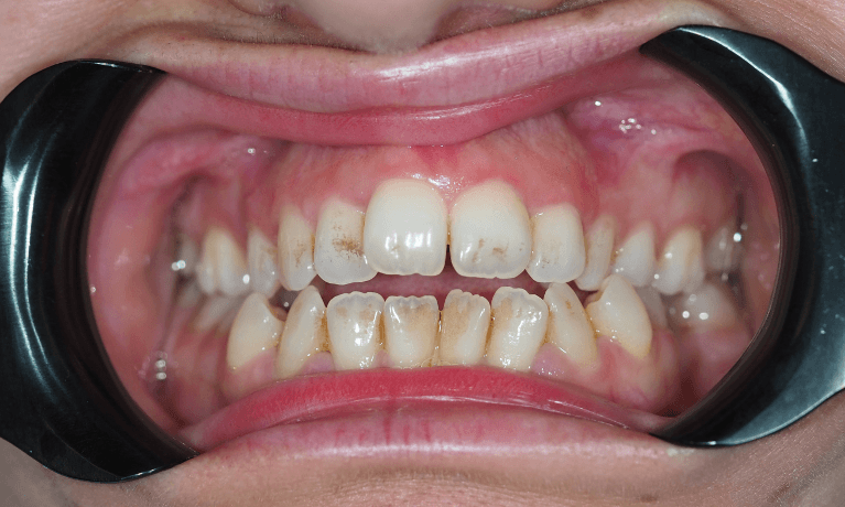 Close up of mouth before a professional dental clean, pascoe vale vic