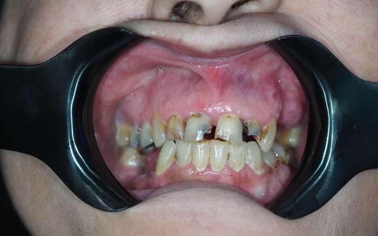 Secondary view of patients mouth before composite bonding, pascoe vale